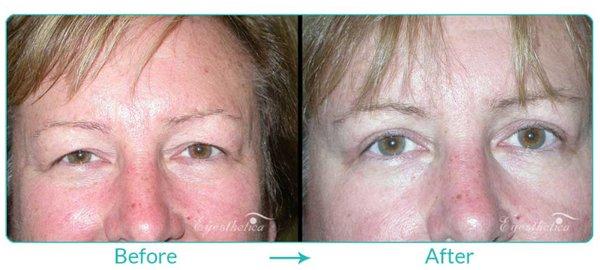 Before and After: Blepharoplasty (Excess Eyelid Skin) by Dr. Steven C. Dresner