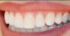 Invisalign Braces