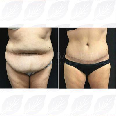 Tummy tuck before & after