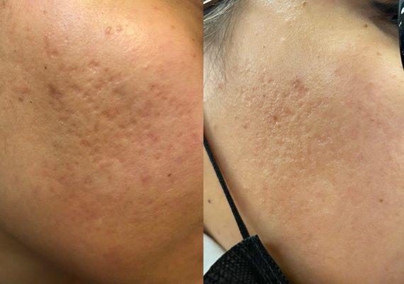 Acne scars before and after 2 Treatments with Miracle Verde' cream