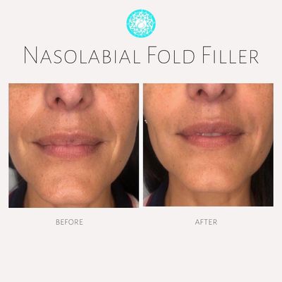 Filler by Master injector Kathy Corbo