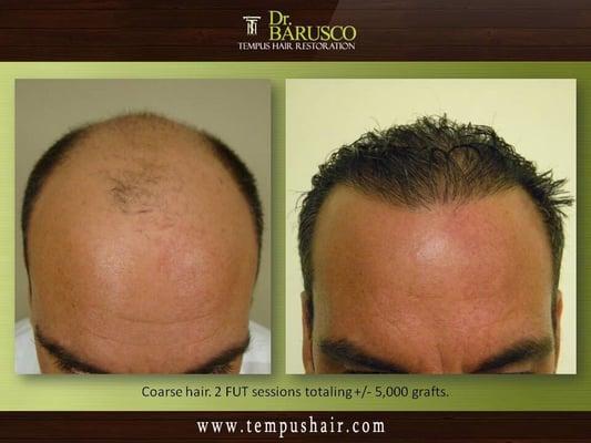 Dr. Marco Barusco actual patient great coverage.