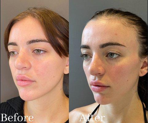 Female 1 Year After Secondary Closed Rhinoplasty