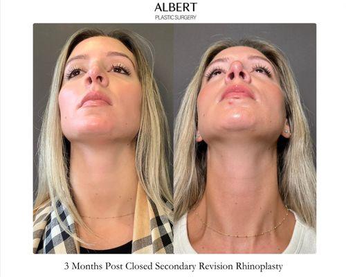 Closed (Scarless) Secondary Revision Rhinoplasty