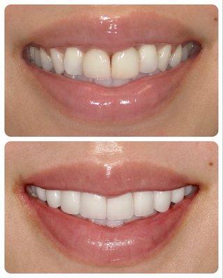 Top is before, bottom is after top 8 veneers