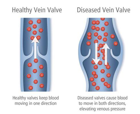 Healthy vein vs diseased vein