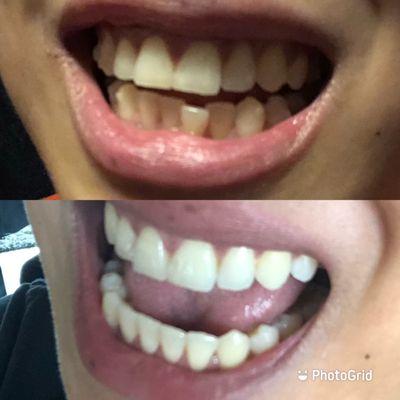 Before and after Invisalign