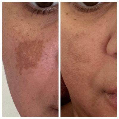 Melasma hyperpigmentation results