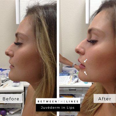 Before and after Juvéderm in lips. A more youthful, plump pout and a more refined profile.