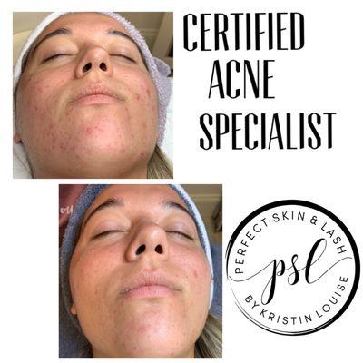 Certified Acne Specialist - client is on her way to clear skin. Book your appointment now to clear your acne!