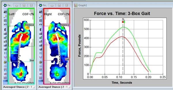 Pressure mapping and custom foot orthotics