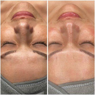 Before and After Face Lift/ Firming Facial