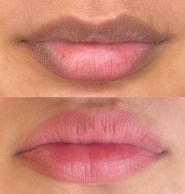 LIP NEUTRALIZATION IN THE WOODLANDS TEXAS