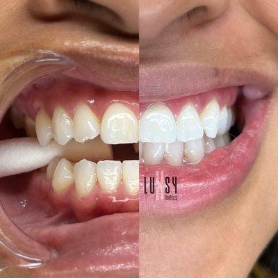 Cosmetic Teeth Whitening