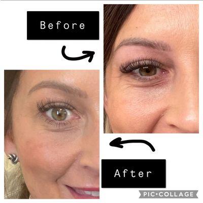 Plasma Fibroblast complete eye lift