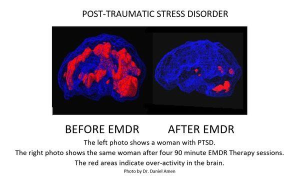 EMDR therapy benefits!