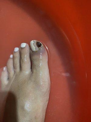 Worsening ingrown infected toenail