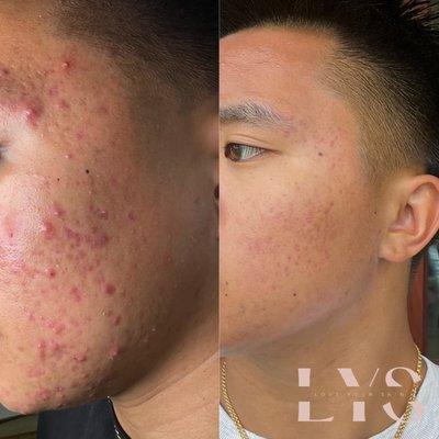 Before & After ACNE BOOTCAMP