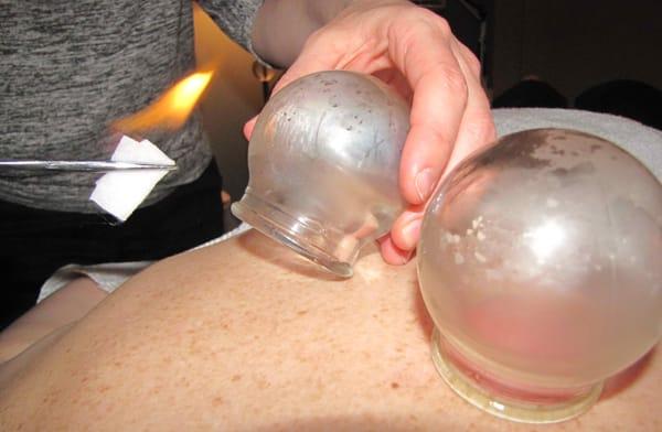 Glass fire cupping therapy