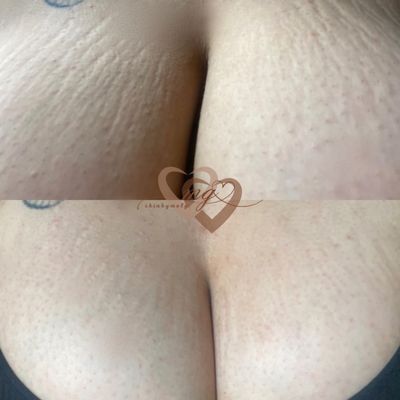 Ink-less stretch mark revision