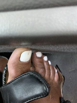 Nail discoloration