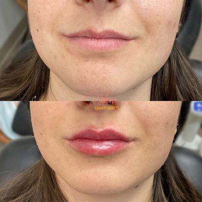 Are thin lips an area you desire to enhance? Then lip filler may be right for you!