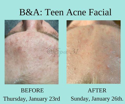 Face Reality Certified Acne Specialist