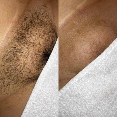 Brazilian Wax