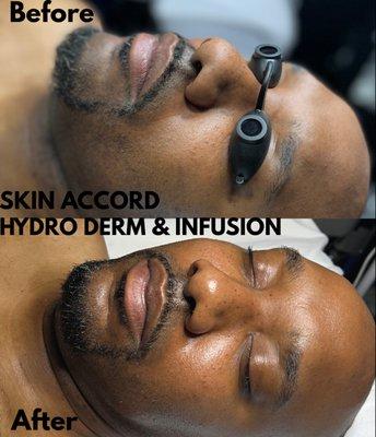 Hydro-derm infusion facial