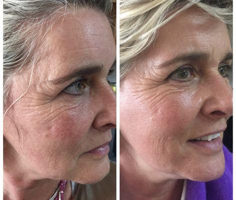 See the transformative results of just one chemical peel treatment for our client.