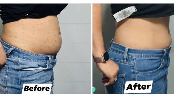 Lipo shots ( full abdomen, and sides )