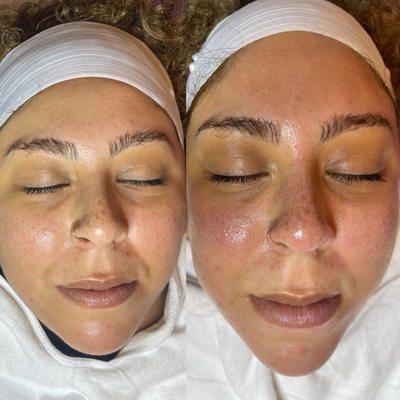 Client results before and after Dermaplaning, Hydrafacial and LED LIGHT Therapy.