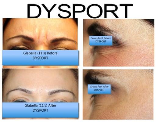 IMC patient before and after Dysport pictures.