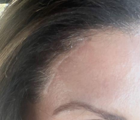 Surgical scar from brow lift