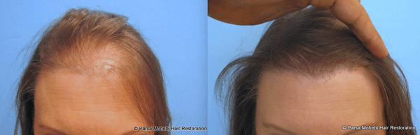 Female Strip Hair Transplant Before and After