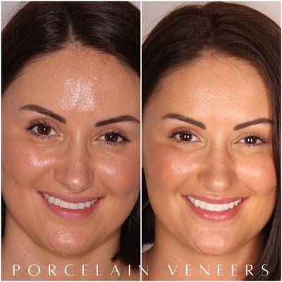 8 porcelain veneers with Dr Kahng