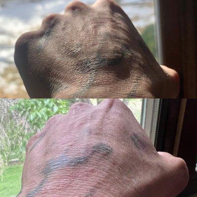 Top photo was 3 months post treatment at Wise Choice Tattoo Removal. Bottom photo is 3 WEEKS post removal at Rocky Mountain!