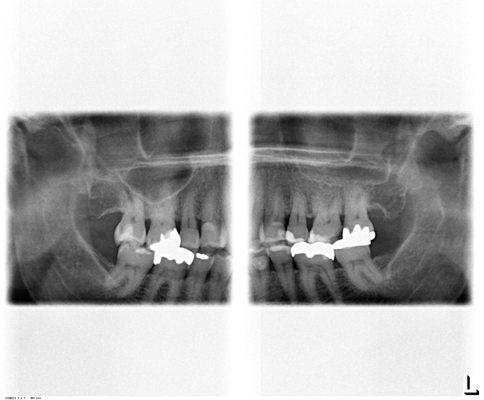 Extra oral bitewings