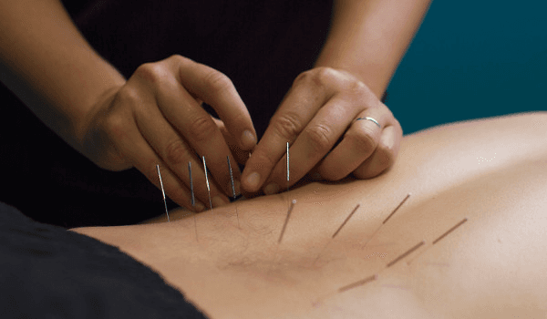 Dry Needling