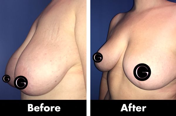 Breast Reduction with Lift Before and After