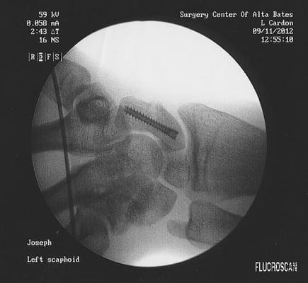 My scaphoid as fixed by Cardon in 2012.