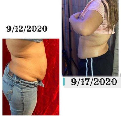 Laser Lipo and Cavitation (fat reduction)