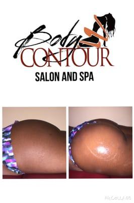 Before and After  Butt Lift Treatment  Call: 7862547972  for your free consultation