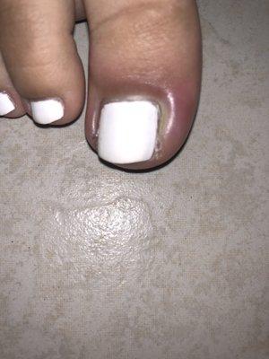 Toe infections