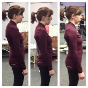 Scoliosis reversed