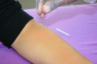 Dry Needling