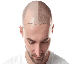 Scalp Pigmentation