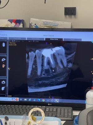 Infections both in the gum and the pulp of the root (from a previous root canal not done so well!)