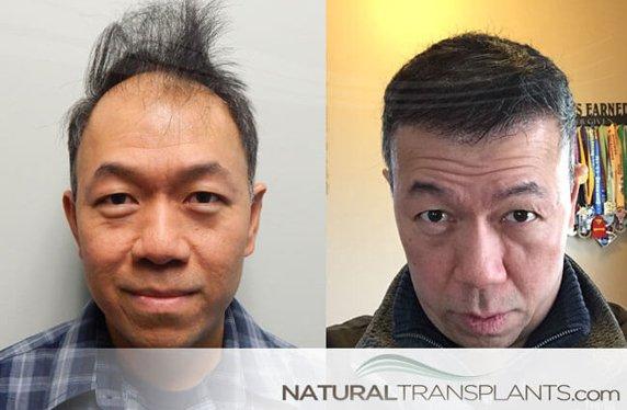 Hair Transplant Methods Call Us 844-327-HAIR (4247) | https://naturaltransplants.com/