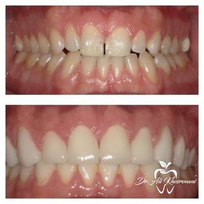 4 Anterior Laminate Veneers